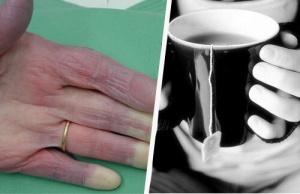 Mistä johtuvat jatkuvasti kylmät kädet?