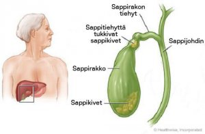 Kärsitkö sappikivistä?