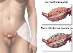 Munasarjojen monirakkulaoireyhtymä: luonnonmukaiset hoidot