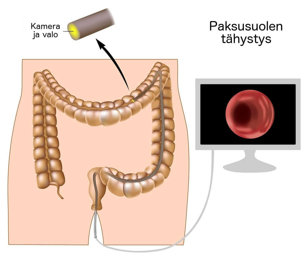 tietoa paksusuolen syövän diagnosoimisesta