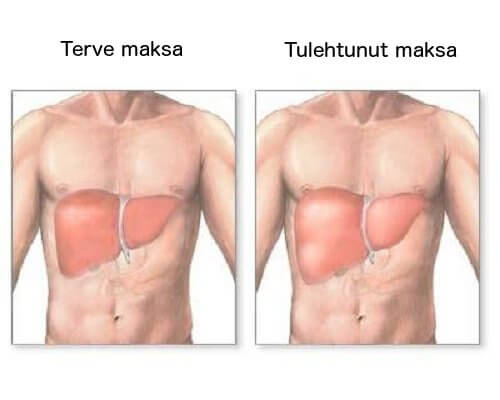 Onko maksasi tulehtunut?