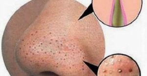 Poista finnit ja mustapäät luonnollisin keinoin