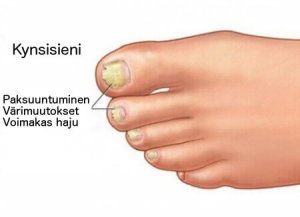 Kynsisienen hoito luonnollisin keinoin