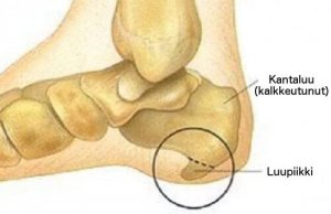 Kantaluupiikki: oireet ja hoito