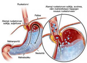 Vinkkejä närästyksen vähentämiseen
