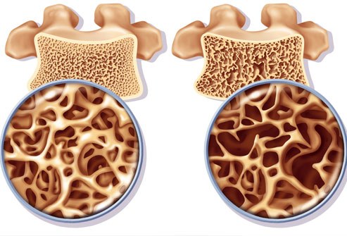 osteoporoosi