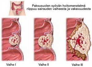 Tämä sinun tulee tietää paksusuolen syövästä
