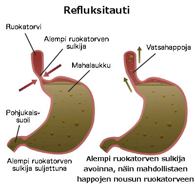 refluksi