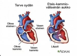7 faktaa sydämen sivuäänistä