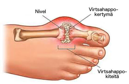 virtsahappoa jalassa