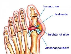 Hankkiudu eroon nivelten virtsahappokiteistä