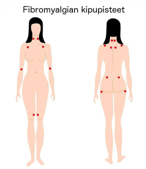 Fibromyalgian kipupisteet