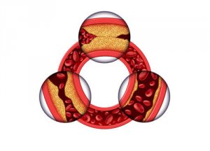 Kolesterolin hillitseminen naisilla
