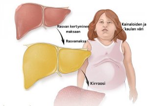Onko sinulla rasvamaksa?