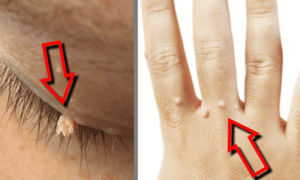 Poista syylät tehokkailla kotikeinoilla