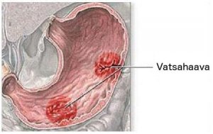 Vatsahaavan oireet