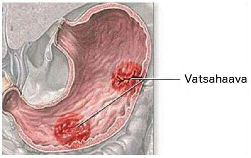 Vatsahaavan oireet