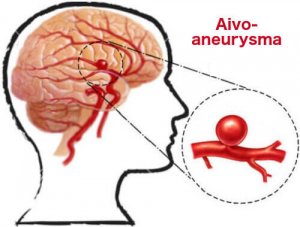 Estä aneurysma ajoissa näillä vinkeillä