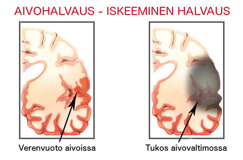 unettomuuden seuraukset: aivohalvaus