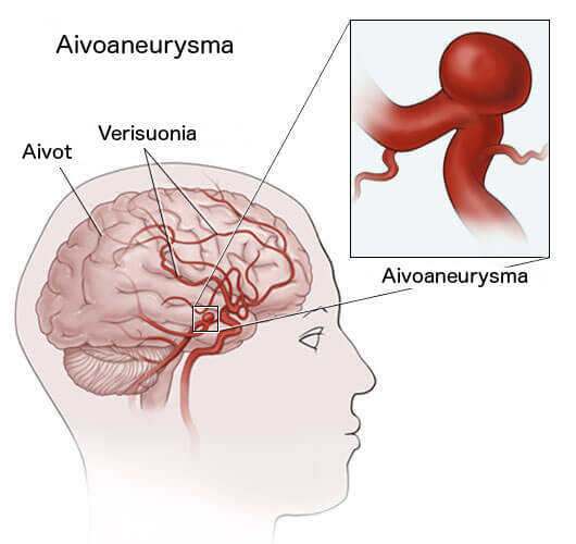 aneurysma-aivoissa