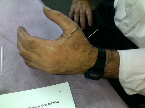 Käden akupunktio