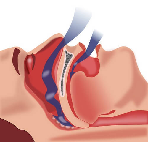 apnea1