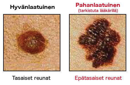 Hyvänlaatuinen ja pahanlaatuinen luomi