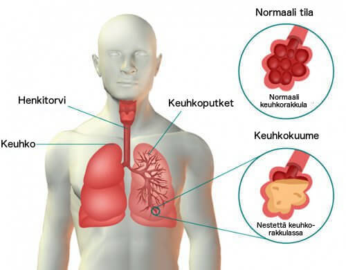 Keuhkokuumeen oireet ja hoitokeinot