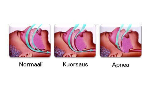 Kuorsaus ja apnea