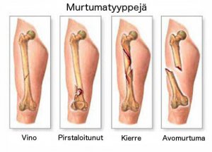 5 primaarisen luusyövän oiretta
