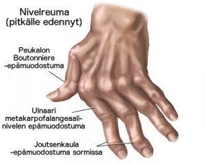 7 luonnollista hoitokeinoa käsien niveltulehduksen hoitoon