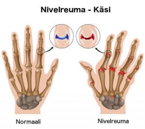 5 yllättävää faktaa niveltulehduksesta