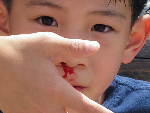 Nenän verenvuoto on yleinen vaiva varsinkin lapsilla.