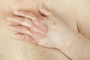 Kotikonstit psoriasiksen hoitoon