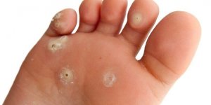 Poista pienet syylät yhdellä aineksella