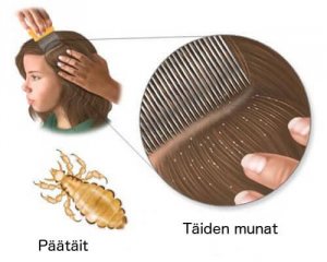 5 kotihoitoa täiden poistamiseksi