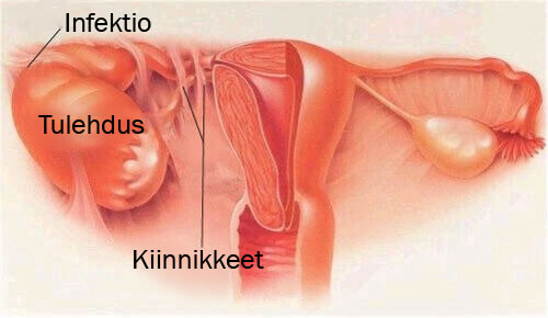 Sisäsynnytintulehduksen oireet