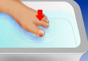 Sisäänpäin kasvavien varpaankynsien hoito