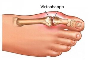 5 parasta teetä vähentämään virtsahappoa