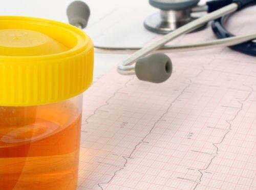 muutokset virtsassa voivat olla merkki syövästä