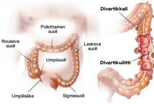 Divertikuliitti ja divertikuloosi: diagnoosi ja hoito