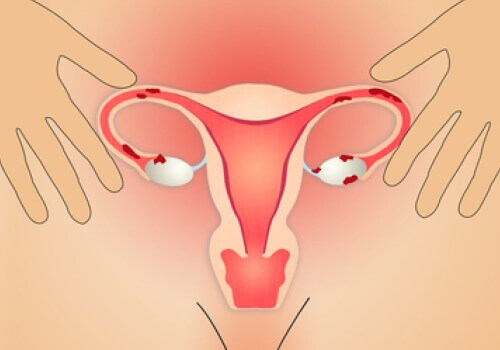 Endometrioosin hoito ravinnon avulla