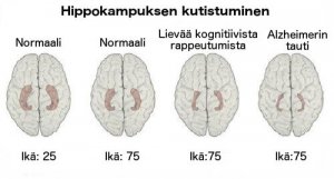 Opi tunnistamaan Alzheimerin varhaiset merkit