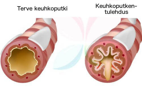 Terve ja tulehtunut keuhkoputki