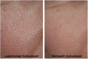 Suurentuneet ihohuokoset? Kokeile näitä naamioita!