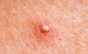 Luonnolliset hoitokeinot paiseille