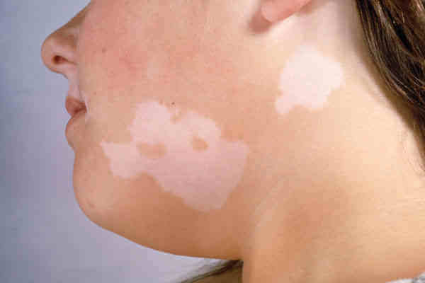valkoiset läiskät iholla: vitiligo