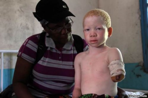 albiinolapselta on amputoitu kädet