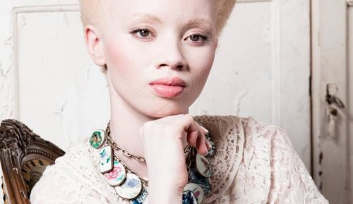 Albinismi: Malli Thando Hopan koskettava tarina