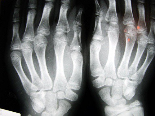 kädet kuvattuina röntgenissä